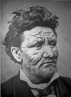 What common animal in the US may carry leprosy?