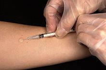 What disease is screened for by the Mendel-Mantoux test?