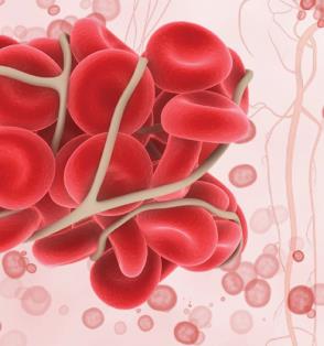 What is a deep vein thrombosis? What is a deep vein thrombosis?