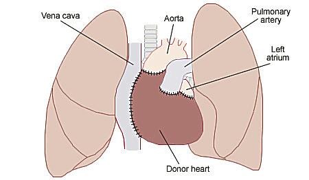 What is the name of the hospital where the first human heart transplant in the world occurred? What is the name of the hospital where the first human heart transplant in the world occurred?