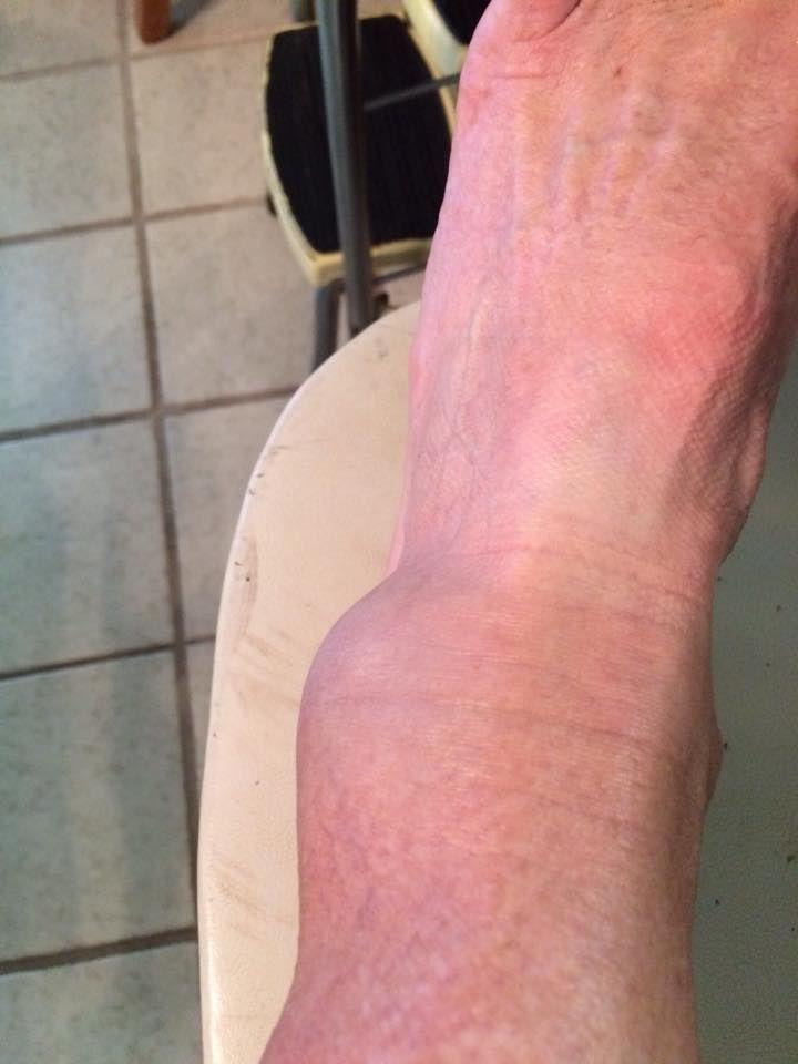 What is an occult fracture?