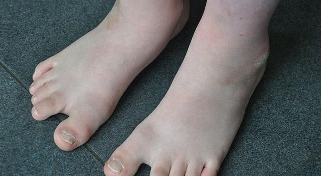 What is Trisomy 21?