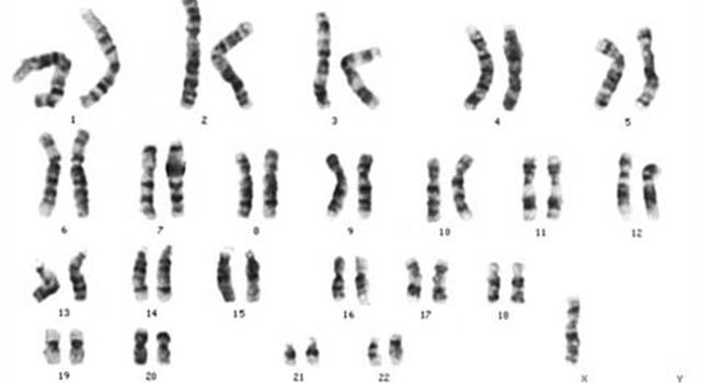 What syndrome is associated with partial or complete missing of one of the X chromosomes?