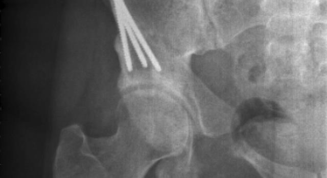 Science Trivia Question: Which bones does "March fracture" usually affect? Science Trivia Question: Which bones does "March fracture" usually affect?