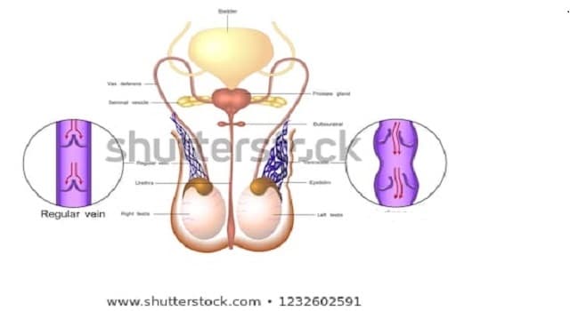 dilatacion de las venas testiculares